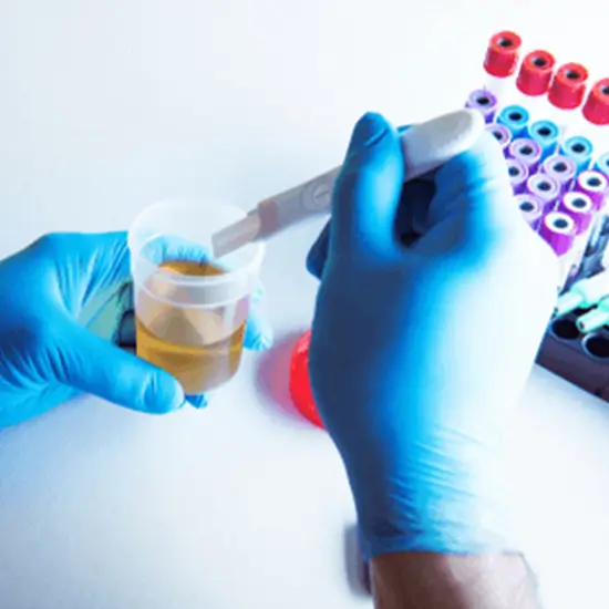 hcg beta total quantitative, random urine test